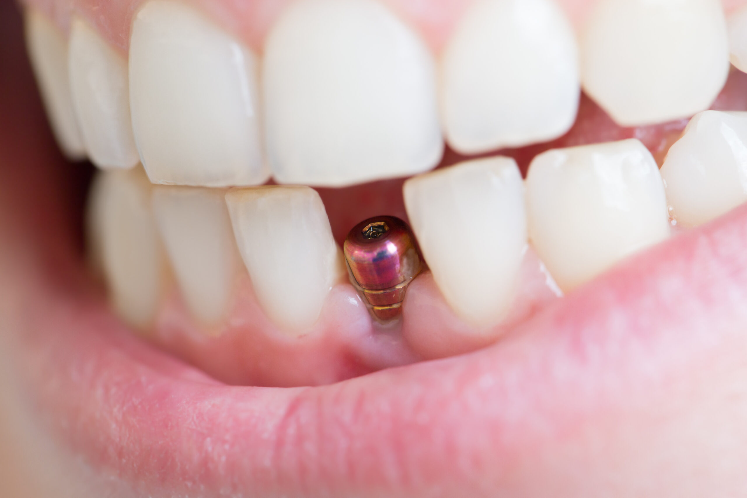 How Do Dental Implants Enhance Your Overall Health?