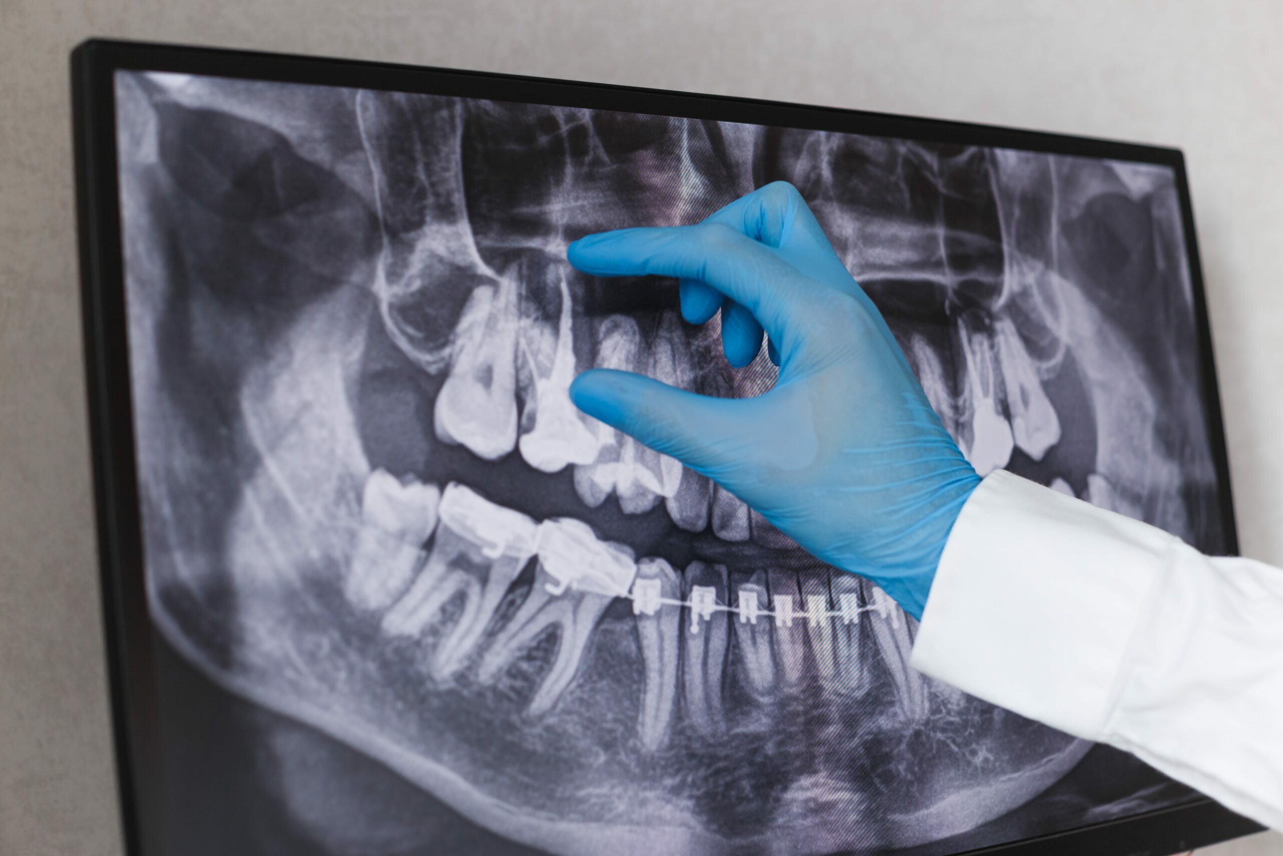 What To Expect During A Root Canal Treatment
