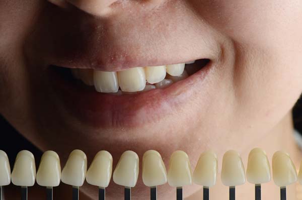 Smile Makeover Procedures FAQs
