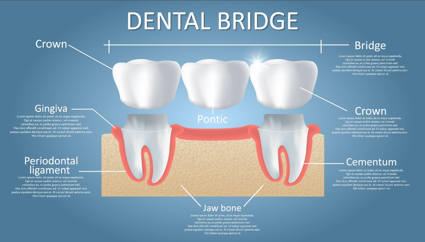 Dental Crown Or Bridge: Which Restoration Is Right For You?