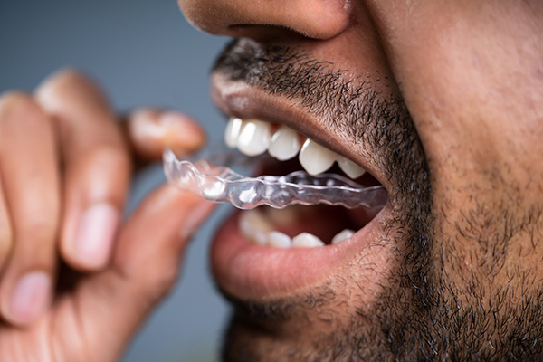 A Cosmetic Dentist Explains Benefits of Clear Aligners from Dental Care of Madison in Madison, MS