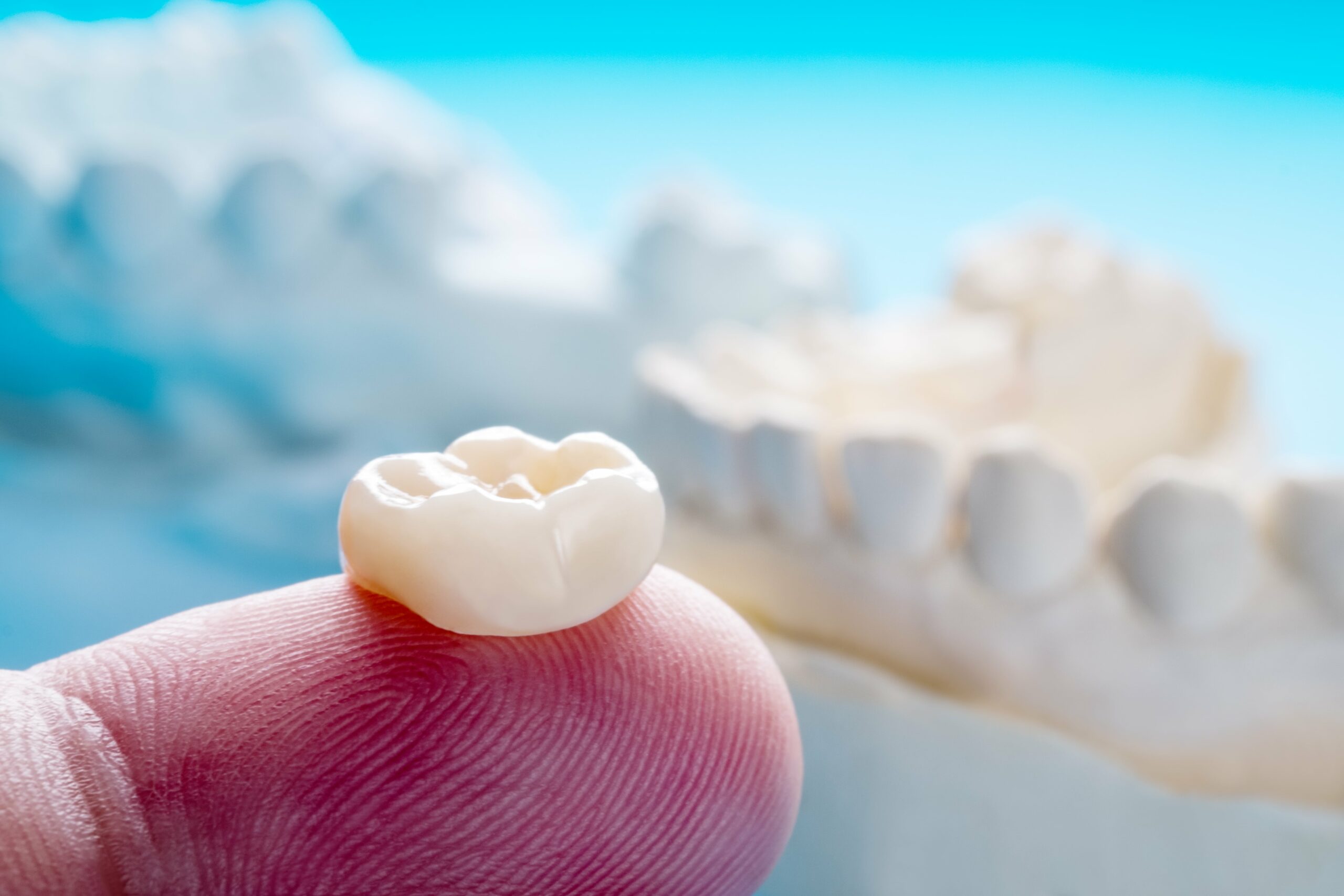 What Are The Benefits Of Dental Crowns?