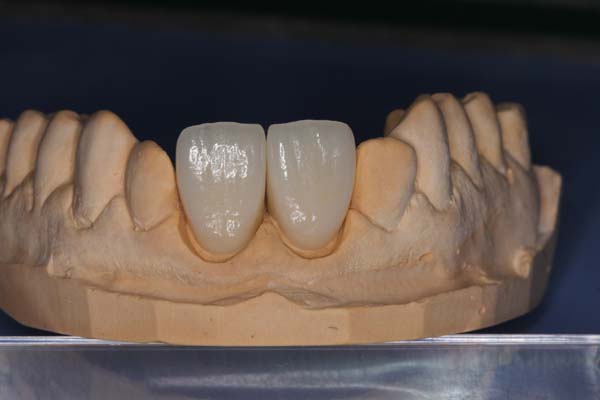 When Is A  Dental Crown Recommended?