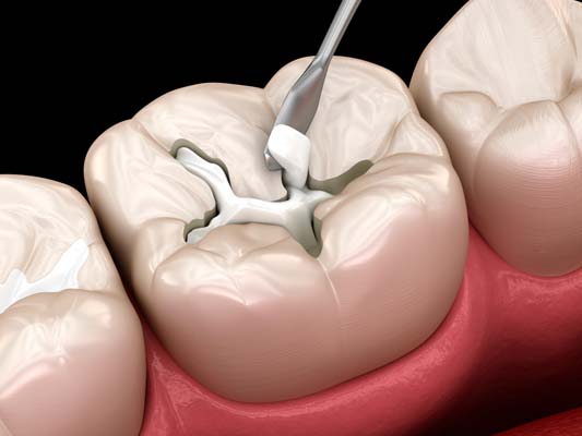 How A Dental Filling Is Used For A Cavity