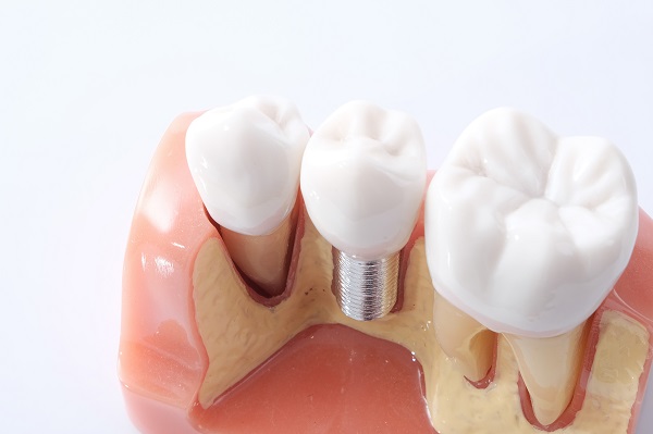 Are There Times When A Dentist Has To Redo A Dental Implant?