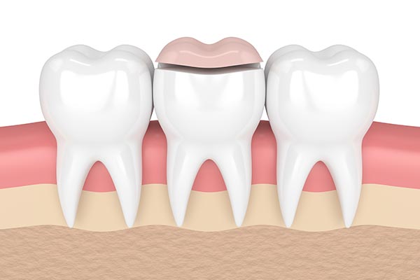 How a Cosmetic Dentist Can Place Inlays and Onlays from Dental Care of Madison in Madison, MS