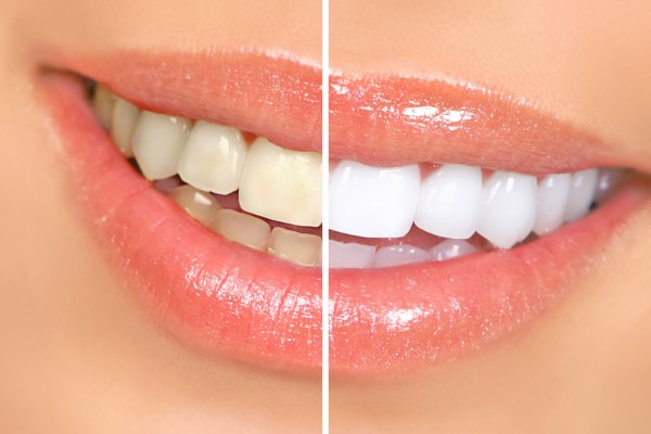 Tips To Minimize Sensitivity After Teeth Whitening